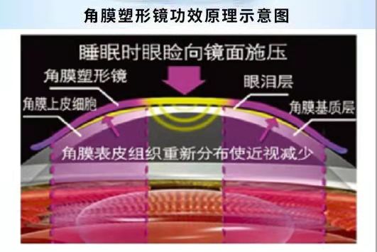 角膜塑形鏡能治愈近視嗎？